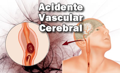 SOLUTION: Sa iv acidente vascular encef lico aulas 11 e 12 1 - Studypool